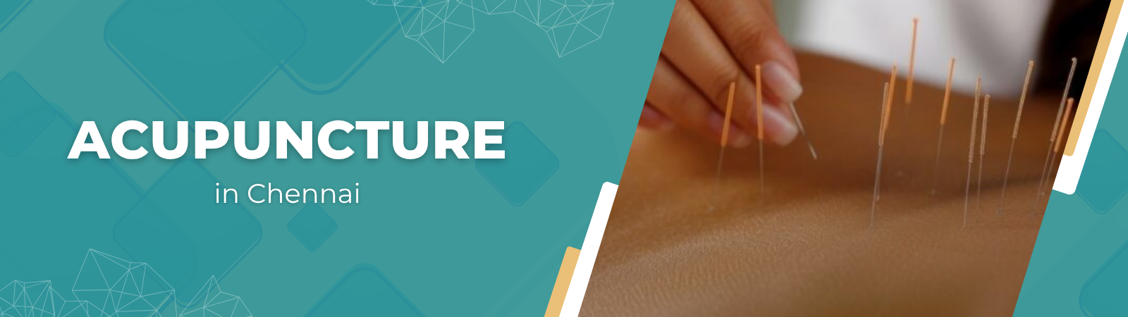 Acupuncture in Chennai-banner